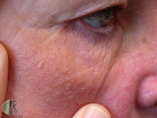 skin aging lesions comedones mole knowledgebase hair care removal ageing symptoms botox treatment medical